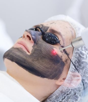 Carbon Laser Peel